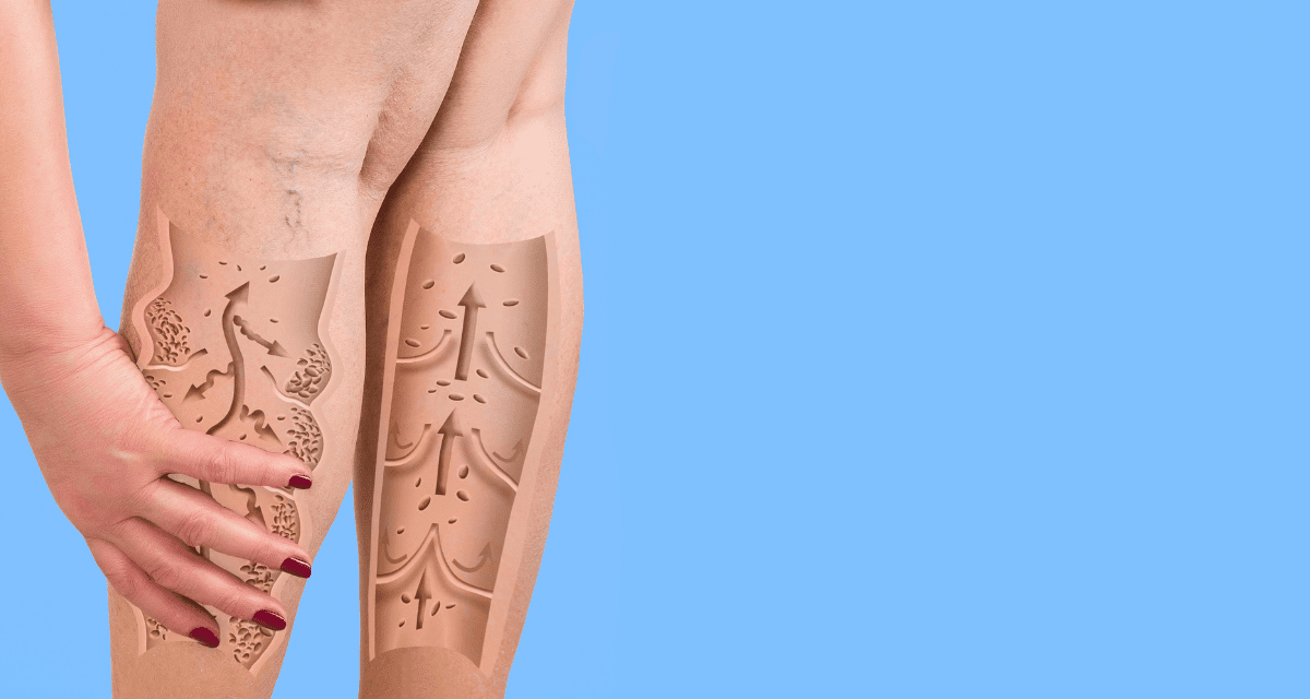 What Helps With Swollen Legs in the Elderly?