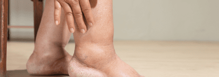 swollen legs in the elderly