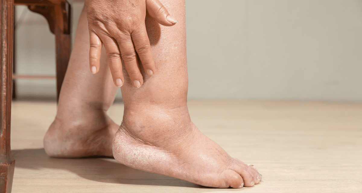 What Helps With Swollen Legs in the Elderly?
