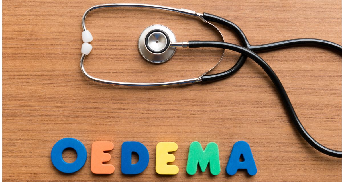 What is Oedema?